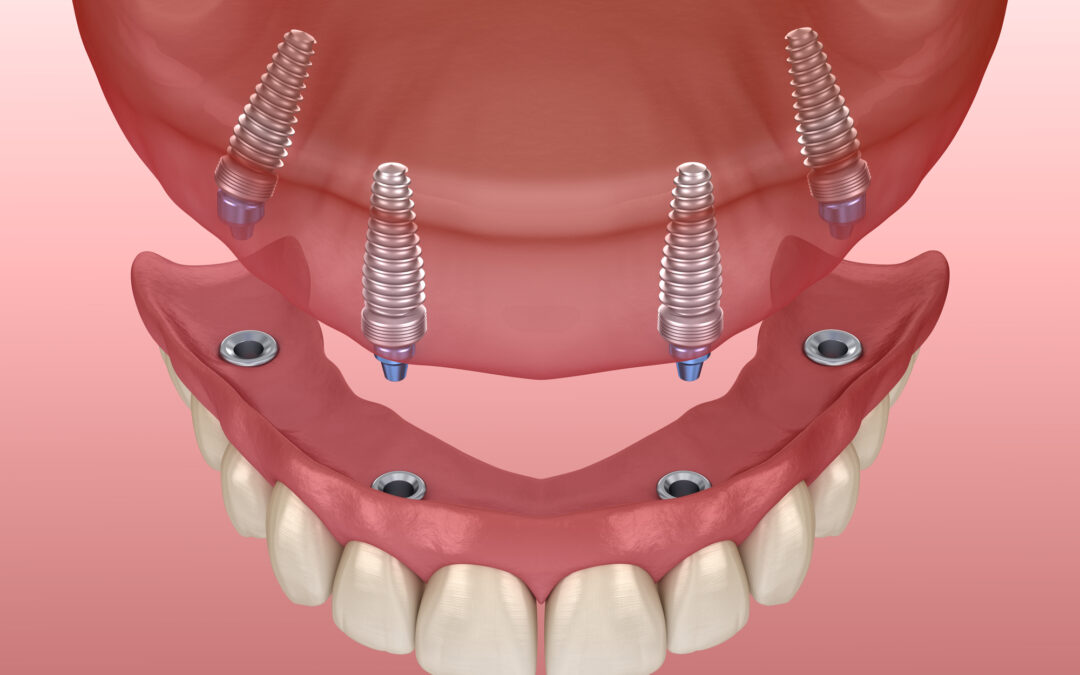 Permanent Dental Implants: Is Titanium a Lifelong Solution?