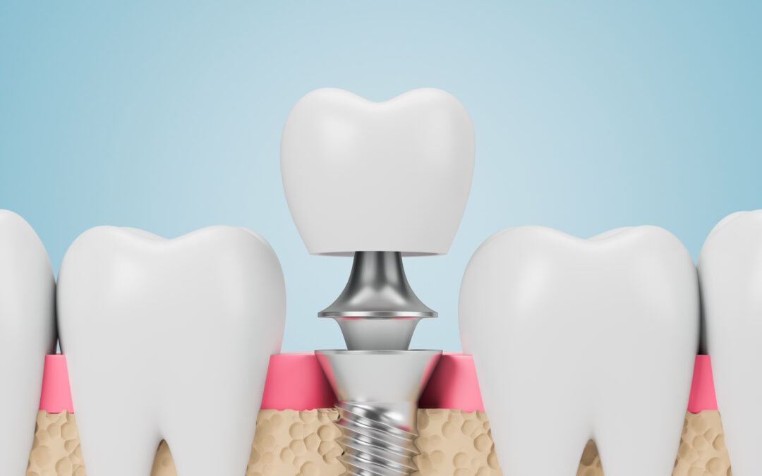 The Future of Dental Implants: Innovations and Emerging Technologies