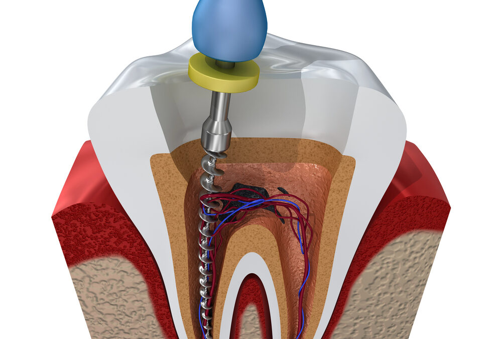 root canal