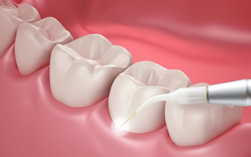 Treating Periodontitis