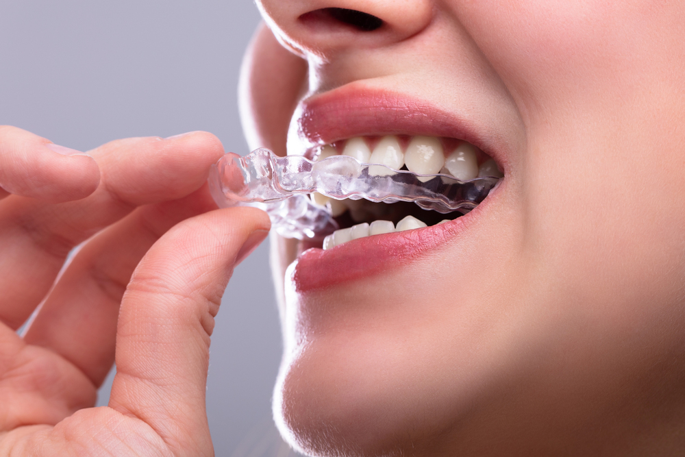 Invisalign