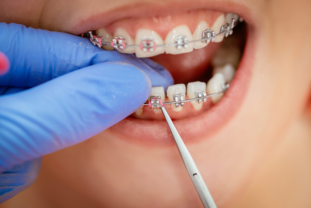 Why Modern Orthodontic Technology Is Delivering More Predictable Smile Results